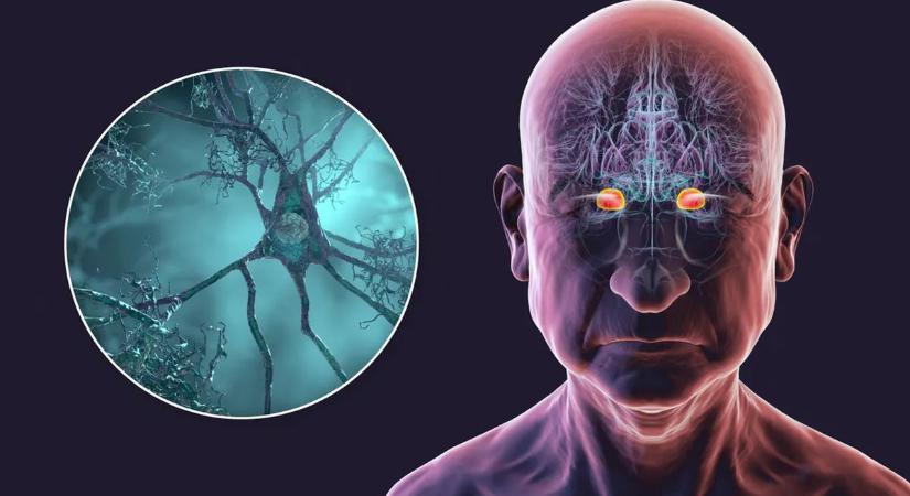 Rémisztő magyarázatot találtak az egyre gyorsabban terjedő demencia okára