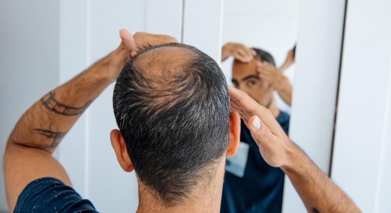 Nem a stressz, nem az anyánk – ezeken a dolgokon múlik valójában a kopaszodás