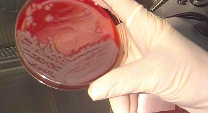 Lépfenét diagnosztizáltak egy páciensnél Magyarországon