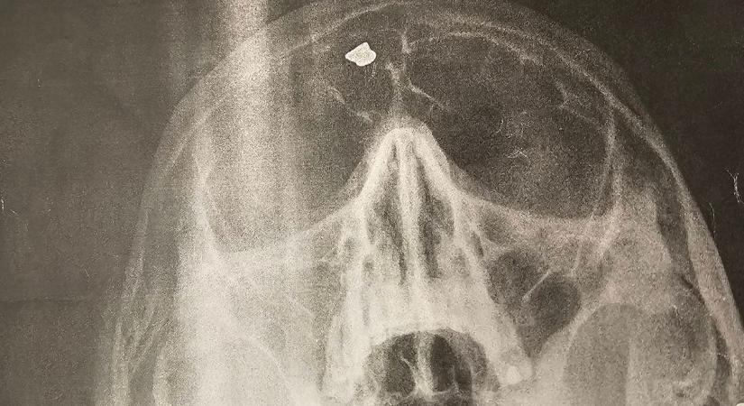 Amit a beteg fejében találtak, az mindenkit lesokkolt, de a gyöngyösi orvos követői ezt is űberelték