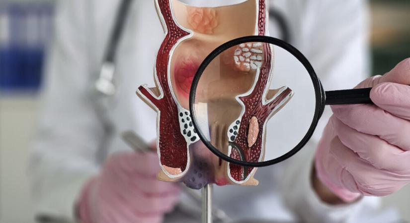 Ecet, alkohol, tehénvizelet – Így ne kezeld az aranyeret!