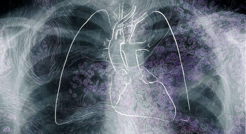 Egyre több fiatalnál diagnosztizálnak tüdőrákot – és nem csak dohányzóknál