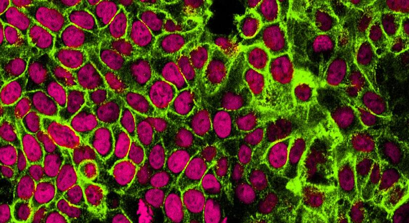 Ez történt: Kiderült, hogy daganatellenes hatása lehet az egyik népszerű gyógyszernek, ami mindenkit lefogyaszt