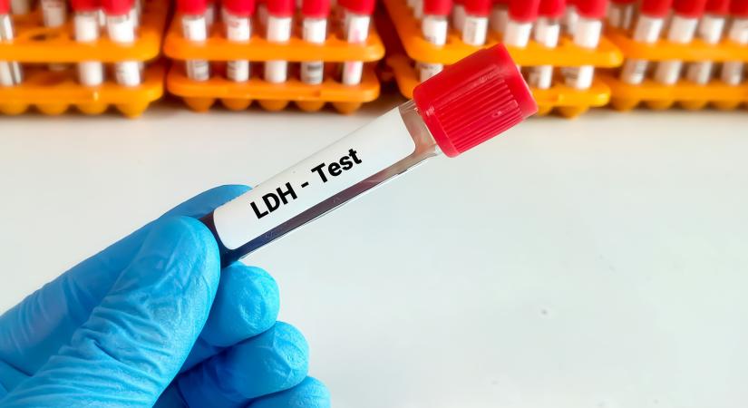 LDH-szint a laborleleten: mit jelent, ha magas? – Fontos problémákra figyelmeztethet