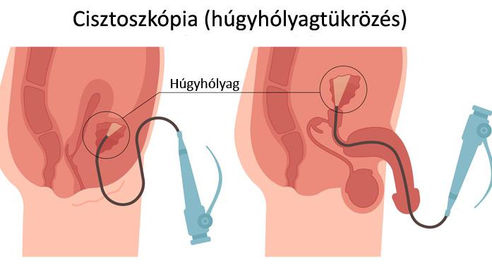 A húgyhólyagtükrözés (cisztoszkópia) menete