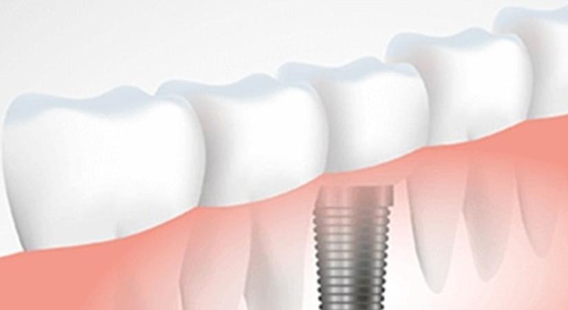 Implantátumok beültetése: hosszútávú és kényelmes megoldás a győri Color-Dent fogászatnál