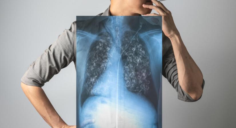 Félmillió ember szenved krónikus tüdőbetegségben, minden harmadik felnőtt dohányzik