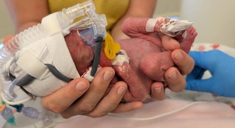 100 nap után hazaengedték a 690 grammal született Alexát a Honvédkórházból