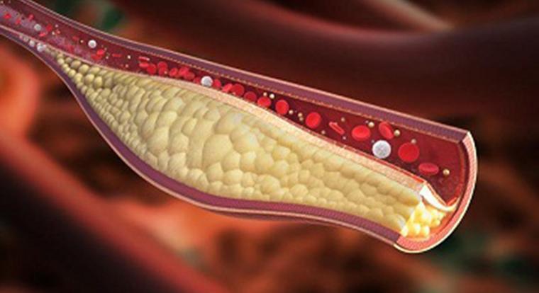 Egy új gyógyszer 58 százalékkal csökkenti a „rossz” koleszterin szintjét