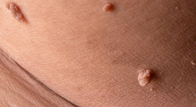 Fibrómák vannak a nyakadon? A tudósok felfedeztek egy aggasztó mintázatot