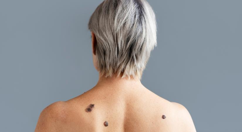 Otthon fagyasztott szemölcsök: 60%-uk kiújul