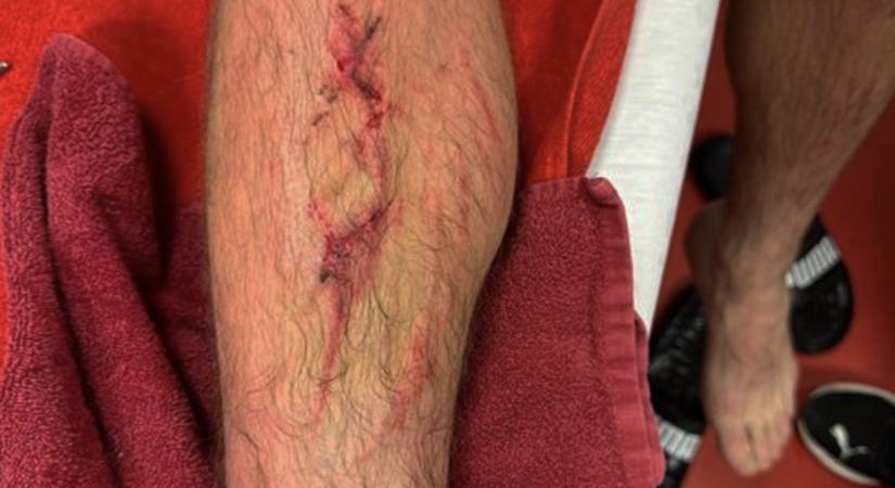 Sallai lába egészen brutálisan néz ki, nem csoda, hogy Törökországban is a magyar játékost védik - fotó, videó