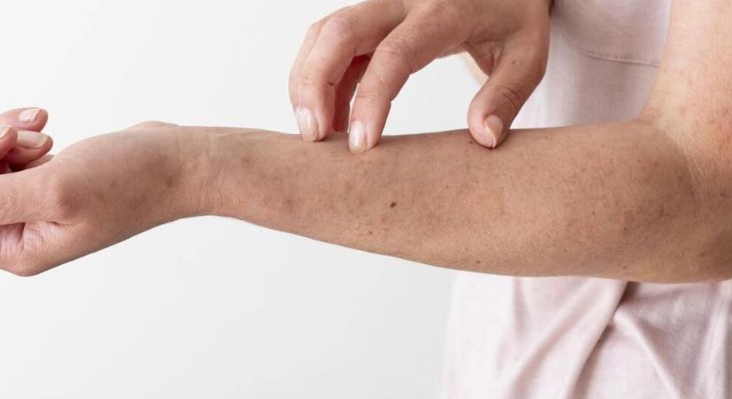 A levegőbe fecskendezett mérge is veszélyes ennek a rovarnak, már Magyarországon is megjelent