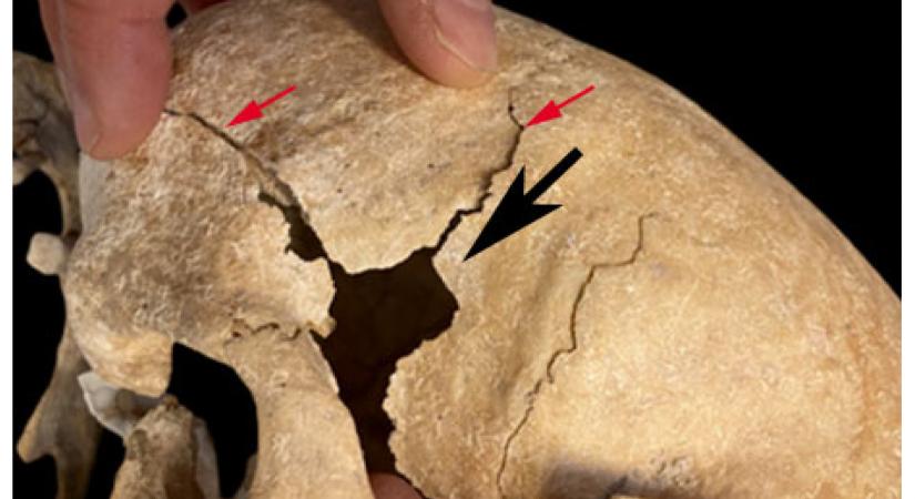 Halálos rendellenességgel élő középkori lovag koponyájára bukkantak Spanyolországban