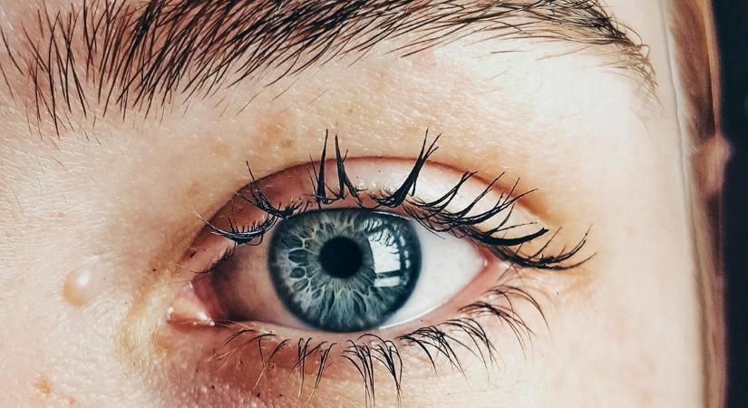 Nézd meg a szemed: ez a két jel koleszterin-problémákról árulkodhat!