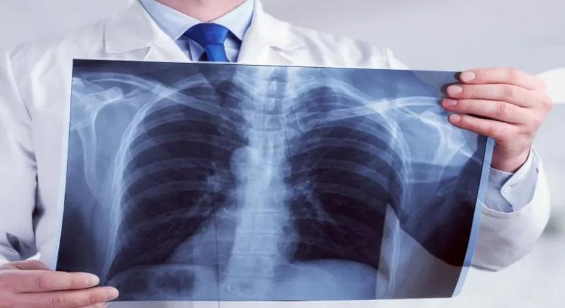 Így fejlesszük a tüdőkapacitást – asztma és COPD esetén különösen