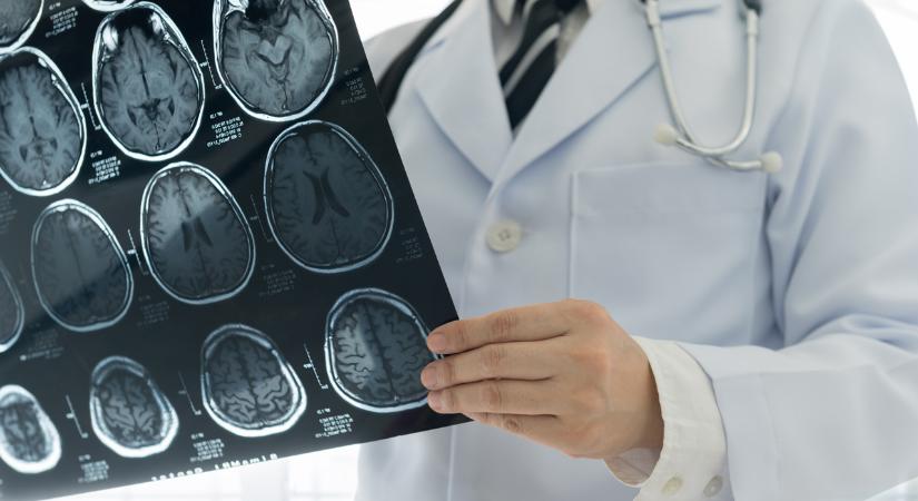 Golyóval a fejében él 40 éve egy gyöngyösi férfi