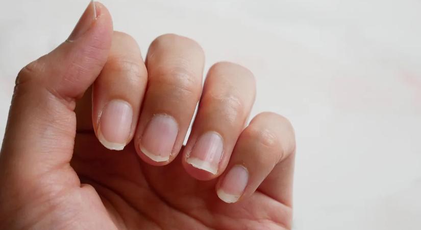 Törik a körmöd és hullik a hajad? Erre van szükséged, ha vitaminhiányod van