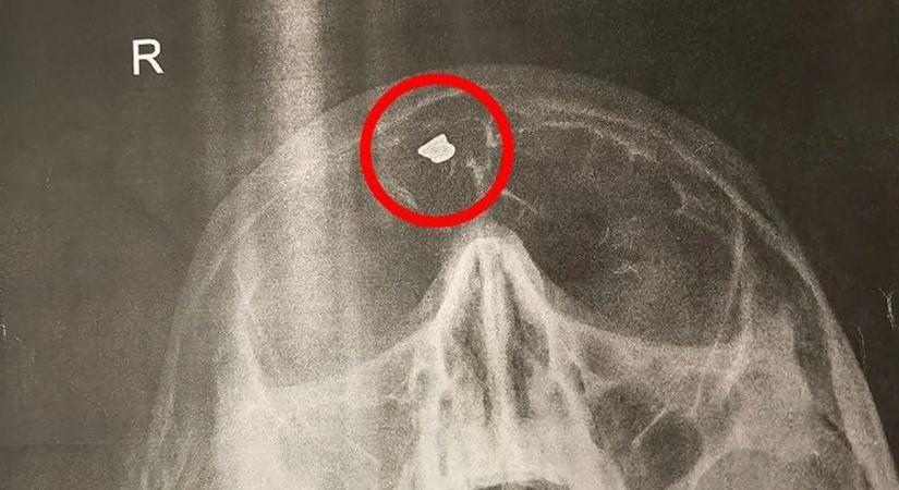 Testvére fejbe lőtte, negyven éve az agyába fúródott lövedékkel él egy magyar férfi