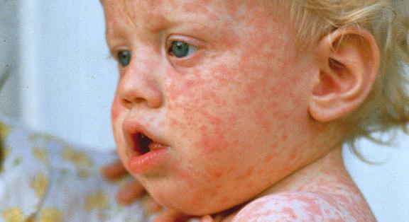 Kanyaró - Tünetek és szövődmények