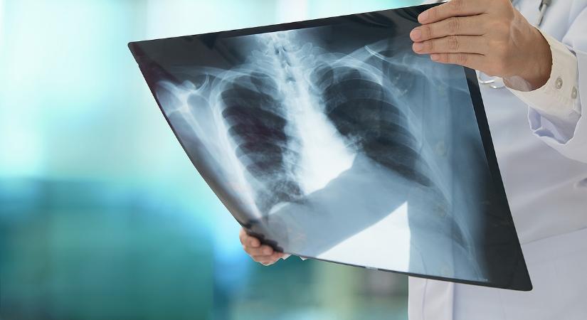 Komoly változás jöhet egy daganatos betegségnél 2030-ra