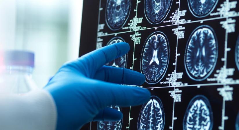 Kiderül, hogy pontosan hány éves kortól kezd hanyatlani az agyunk