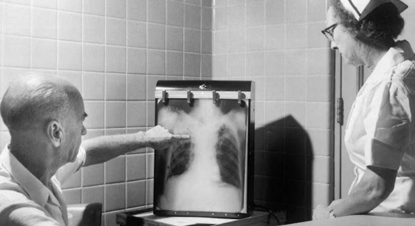 A betegség, amely átformálta a világot – és ma is velünk él: a tuberkulózis meglepő története