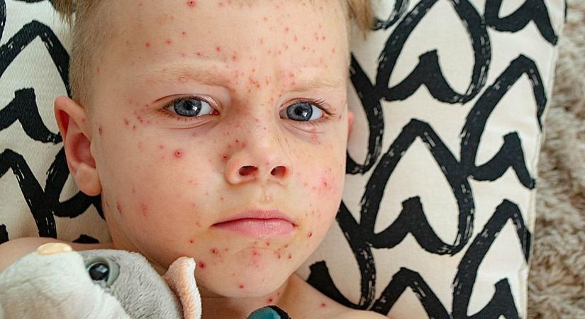 A bárányhimlő oltás életmentő is lehet - megszólalt az orvos