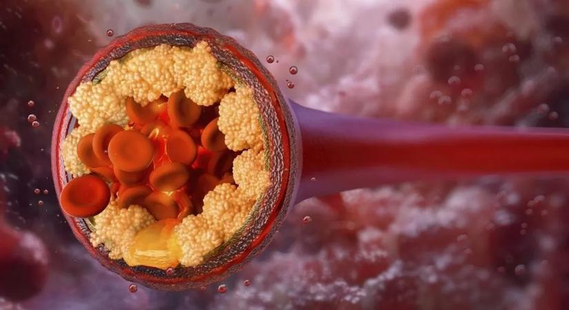 Ez a gyógyszer lehet a következő nagy dobás a szívbetegségek ellen