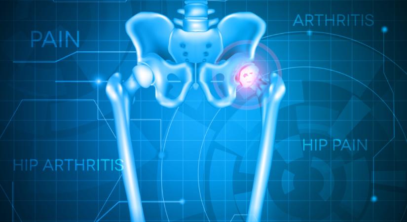 Egészségügyi siker: már a csípőprotézis-műtétek is robotasszisztálttá váltak ezen a klinikán