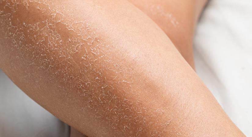 Neked is „hull a bőröd” a lábszáradról? Ezért gyakori a téli időszakban és ez fog segíteni