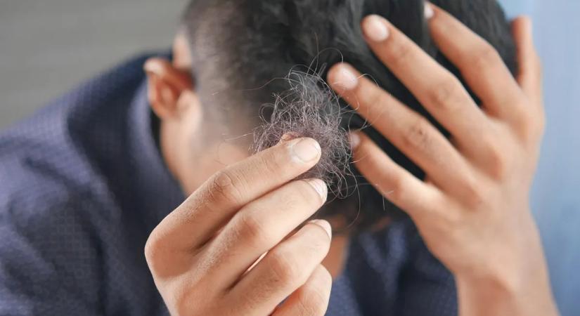 Szakértők figyelmeztetnek: ez a gyakori téli szokás kopaszodást okozhat