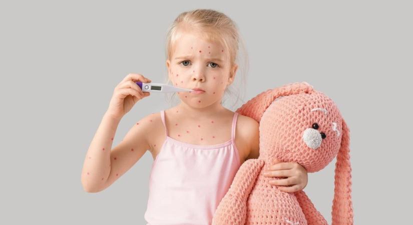 Hólyagok, láz, szövődmények: a bárányhimlő, amit nem érdemes félvállról venni