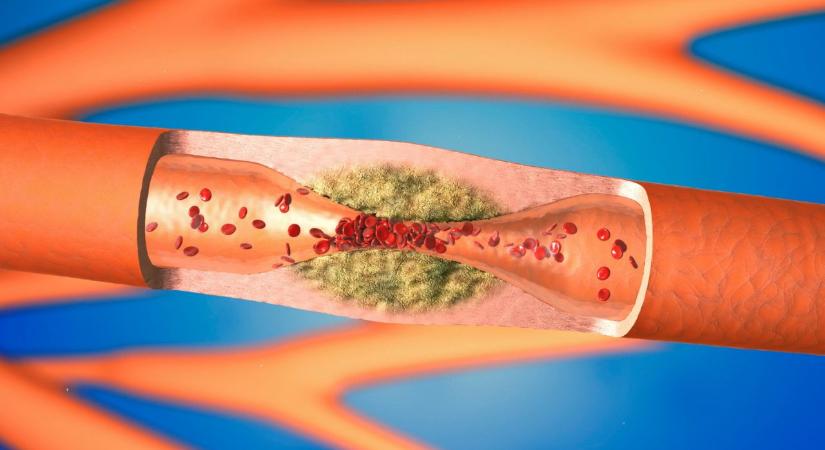 Az érsebész 3 természetes módszert javasol az artériák tisztán tartására és a szív egészségének védelmére