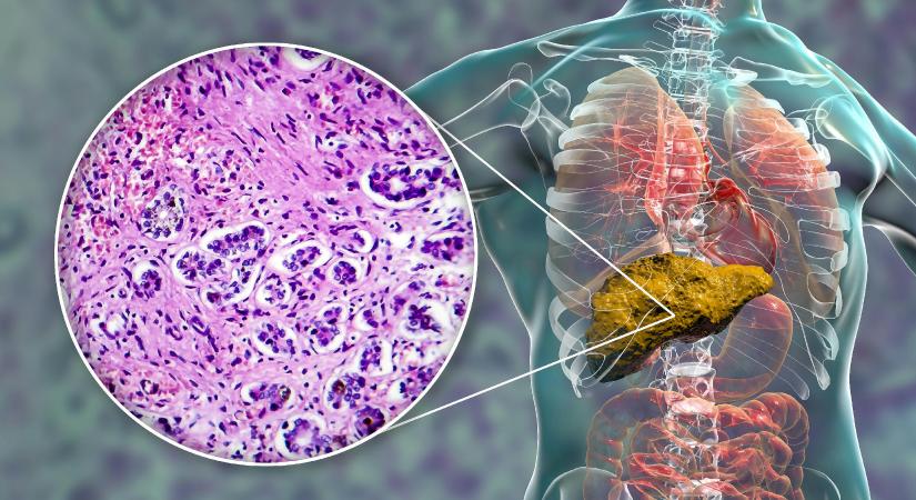 Hiába a teljes leszokás az alkoholistáknál, még utána is meg kellene oldani valamit