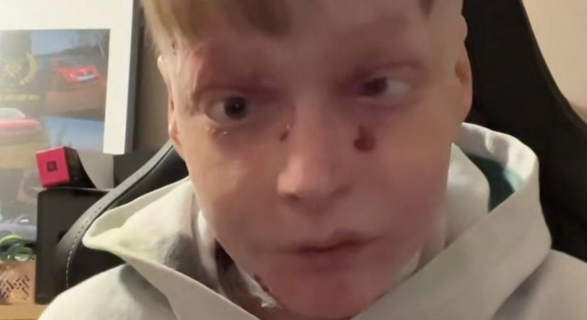„Lehet egy kis időre abba kellene hagynom...” - a pillangóbőrrel küzdő Flórián TikTok fiókját ezért függesztették fel