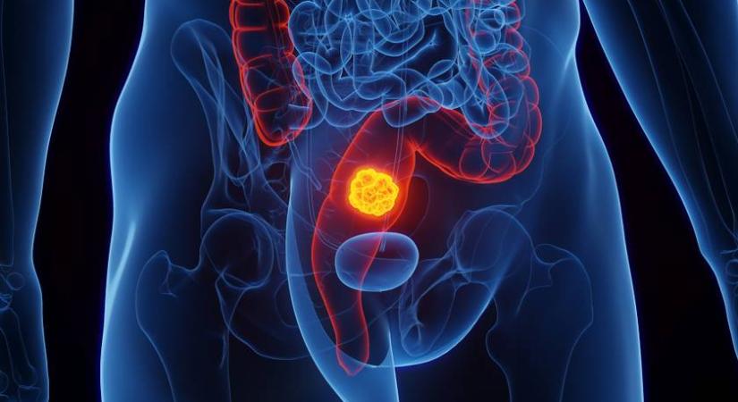 Vastagbélrákot okoznak: ezekkel az ételekkel már 50 éves kor előtt kialakulhat a betegség