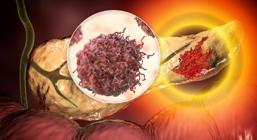 Boltban kapható immunterápia a hasnyálmirigyrák ellen?