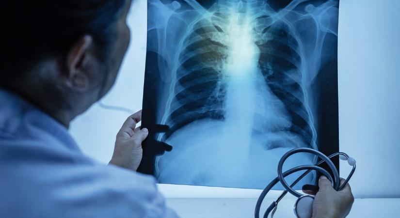 Egy helyen említi Magyarországot a jelentés: egyre több magyar nőnek van gond a tüdejével