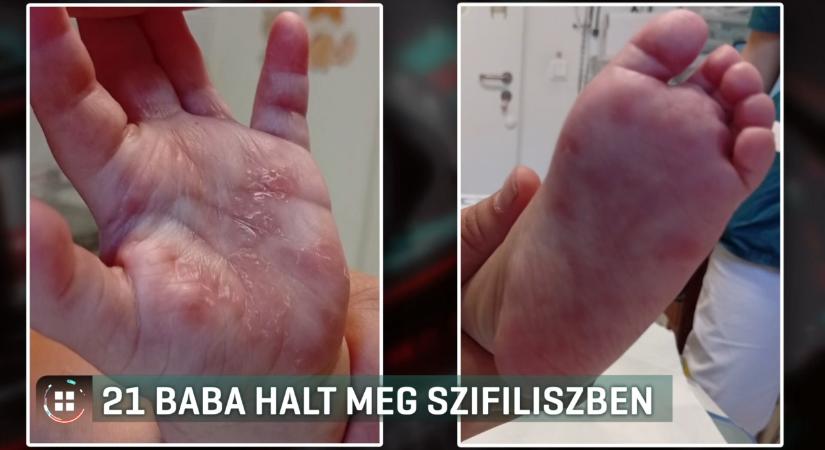 21 csecsemő halt meg idén veleszületett szifilisz miatt