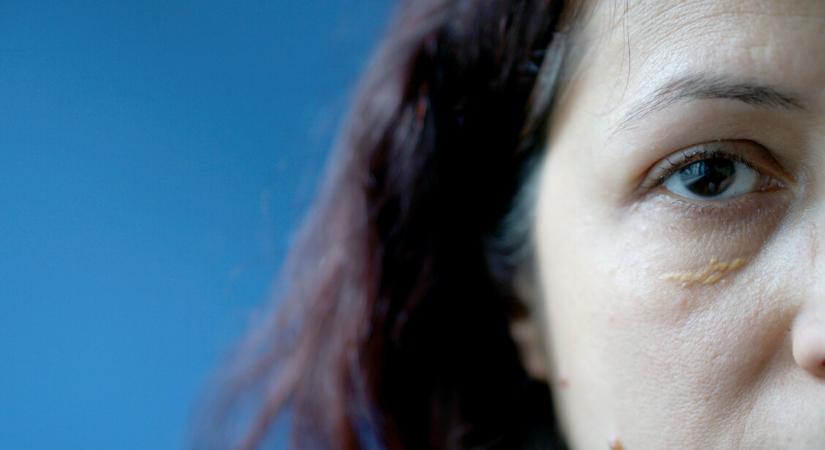 Sárga foltok, kemény dudorok – a bőröd figyelmeztet a magas koleszterinszintre