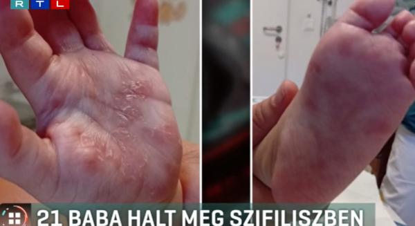 Sokkoló: idén már 21 magyar csecsemő halt meg szifilisz miatt