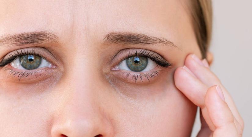 Karikás szemek, ráncos, száraz bőr – Meglepő dologra figyelmeztetnek a tünetek