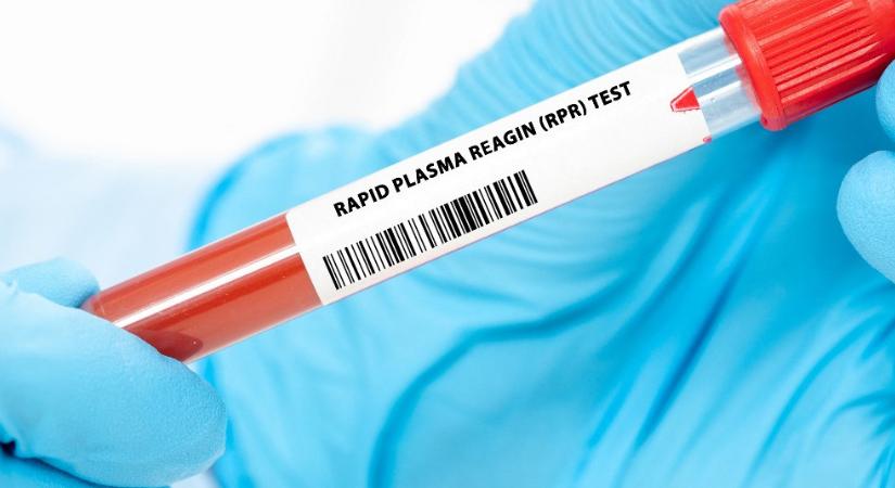 Járványügyi szakértő figyelmeztet: szifilisz fertőzés söpör végig az országon