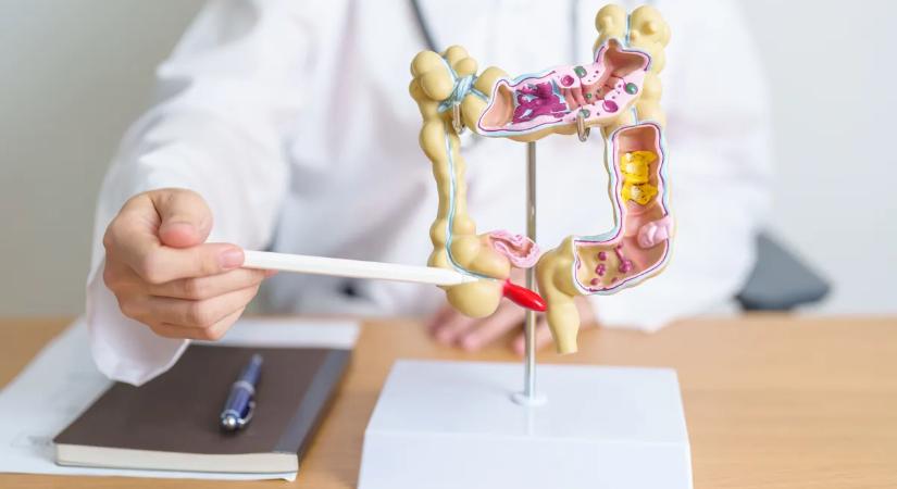 Veszélyes, mert sokáig tünetmentes: így ismerd fel a bélpolipot