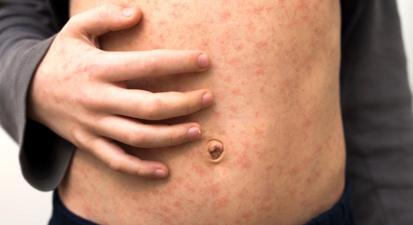 Rettegett betegség tért vissza: vészharangot kongat a WHO, rengeteg gyerek lehet veszélyben