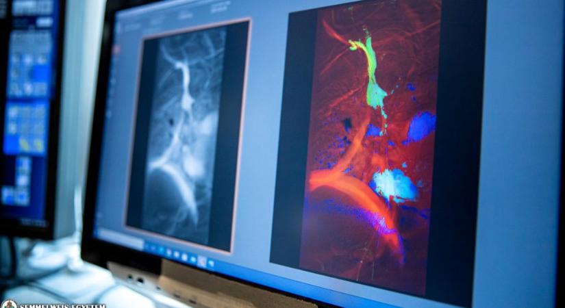 Új magyar technológia forradalmasítja az angiográfiás vizsgálatokat