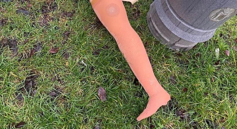 Valaki szó szerint letáncolta a lábát a szombat esti buliban