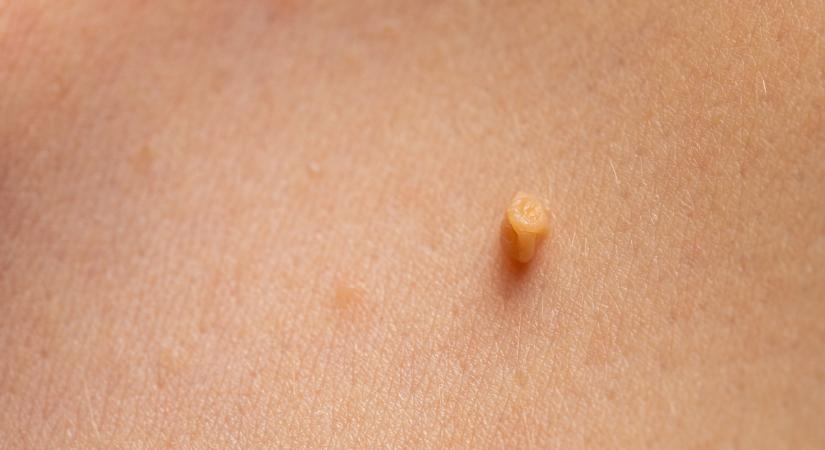 Időskori bőrnövedékek – Így távolíttassuk el lézerrel!