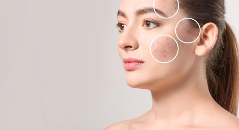 Ez a népszerű vitamin okozhatja az arcon és a háton lévő csúnya pattanásokat: az aknék valódi kiváltója lehet